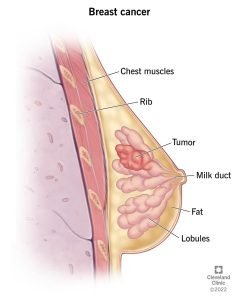 Breast Cancer Symptoms & Treatment